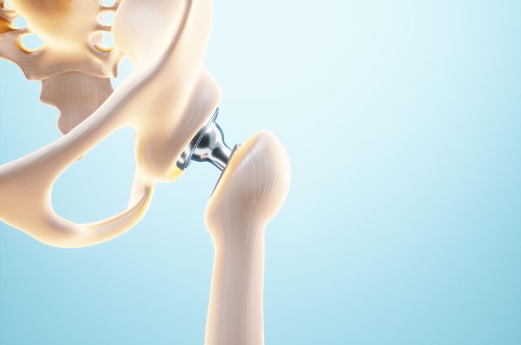 Hip & Knee Replacement Surgery